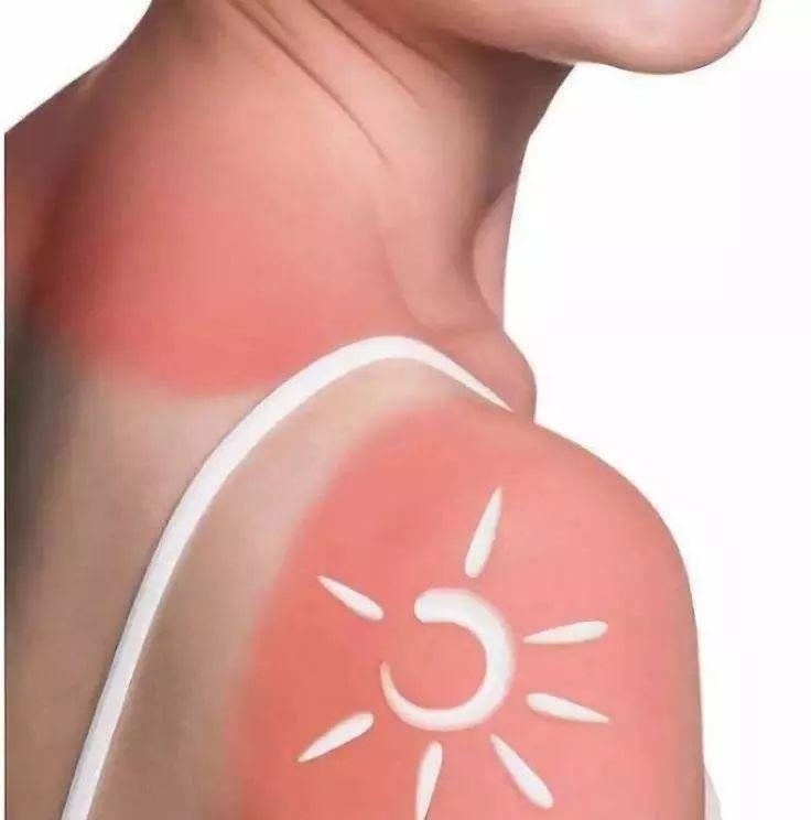 夏季高溫給皮膚帶來的傷害有哪些？