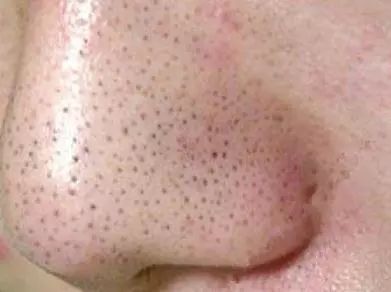 “草莓鼻”該怎么改善？