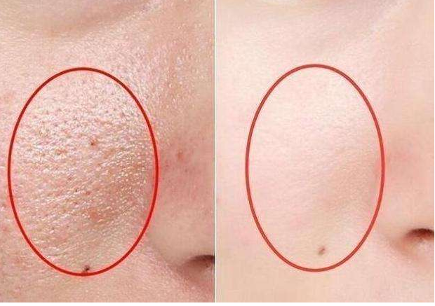 毛孔粗大？有解決辦法