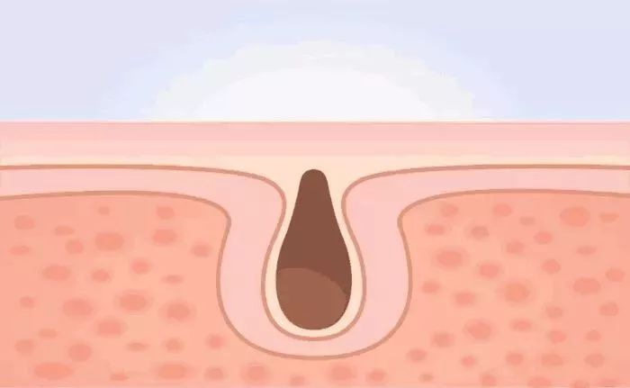 毛孔粗大到底應該怎么辦？