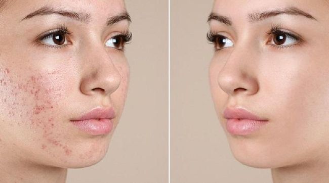 反復長痘，到底如何護膚？