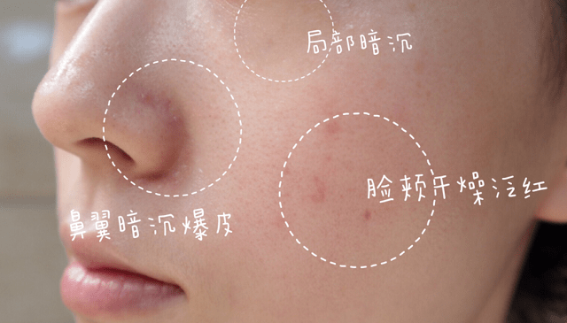 皮膚敏感的原因是什么？皮脂膜受損該如何補救？